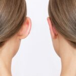 efekt po operacji korekcji uszu