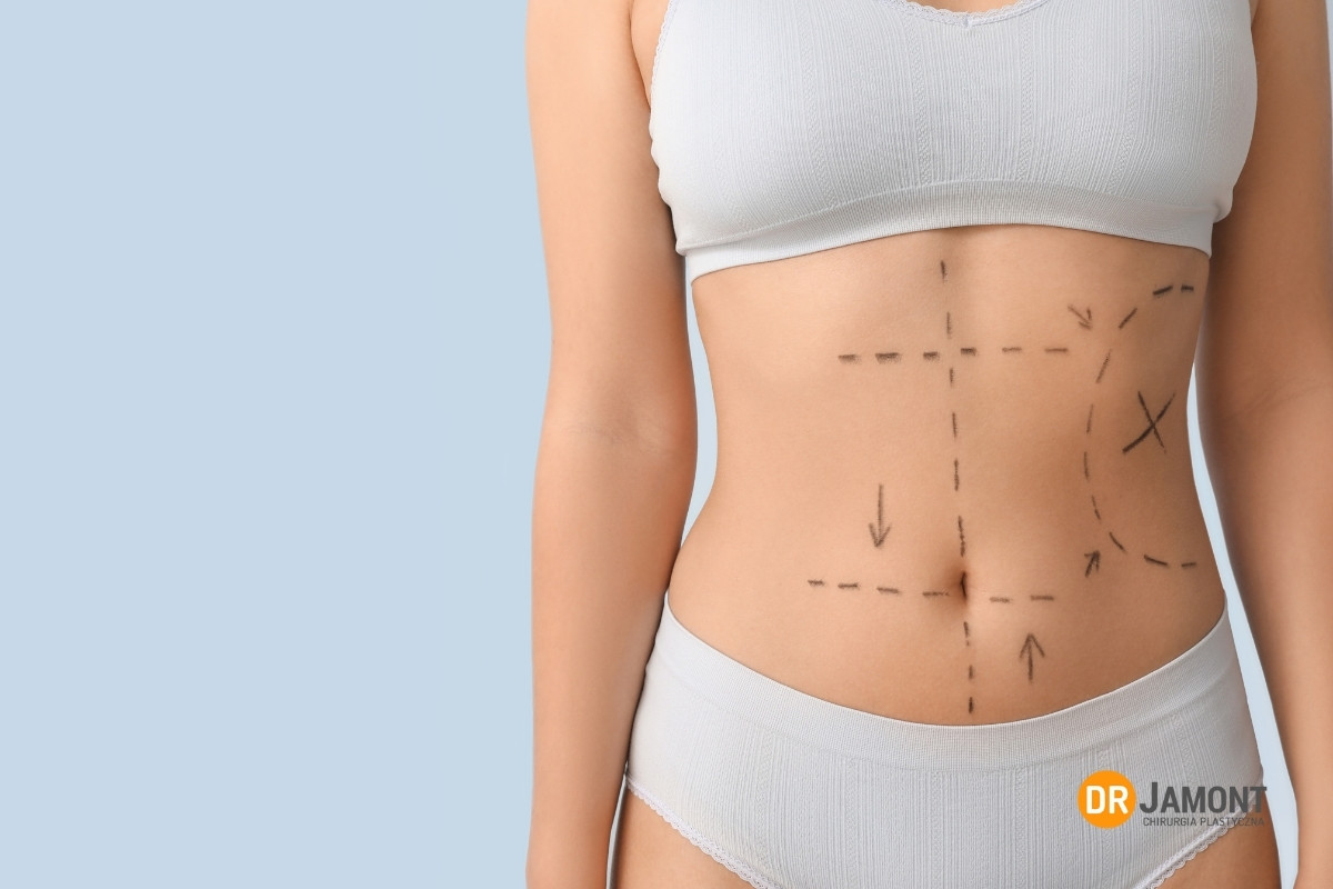 seroma po liposukcji