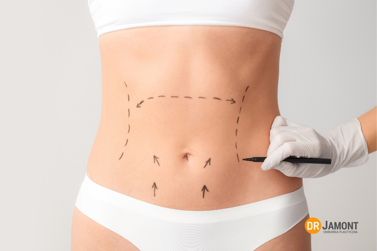 adhezje po plastyce brzucha