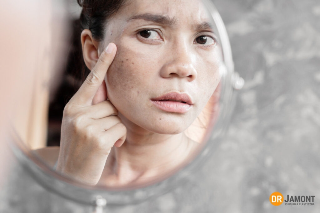 melasma pozabiegowa