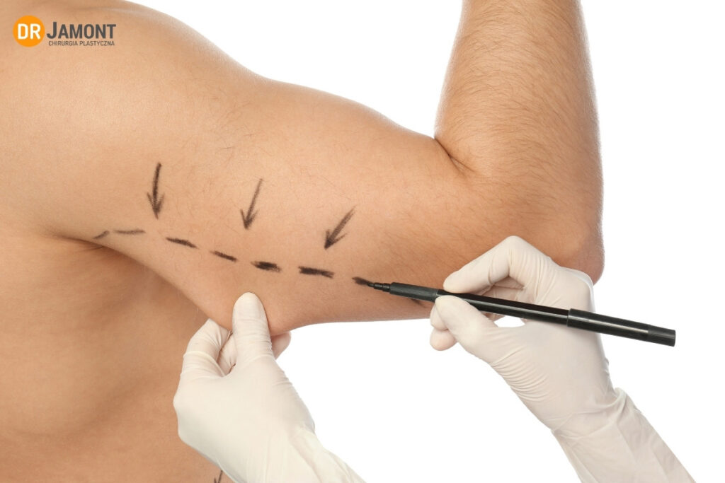 operacja wiotkich ramion