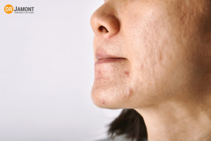 blizny potrądzikowe jak redukować