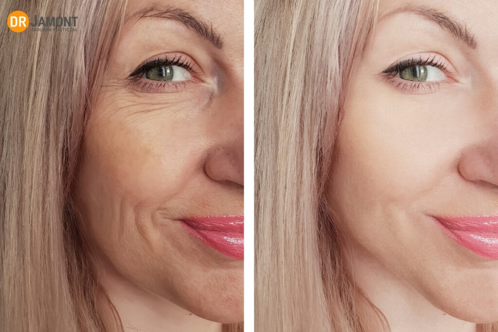 bruzdy nosowo-wargowe przed i po