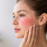 zaczerwieniona skóra twarzy